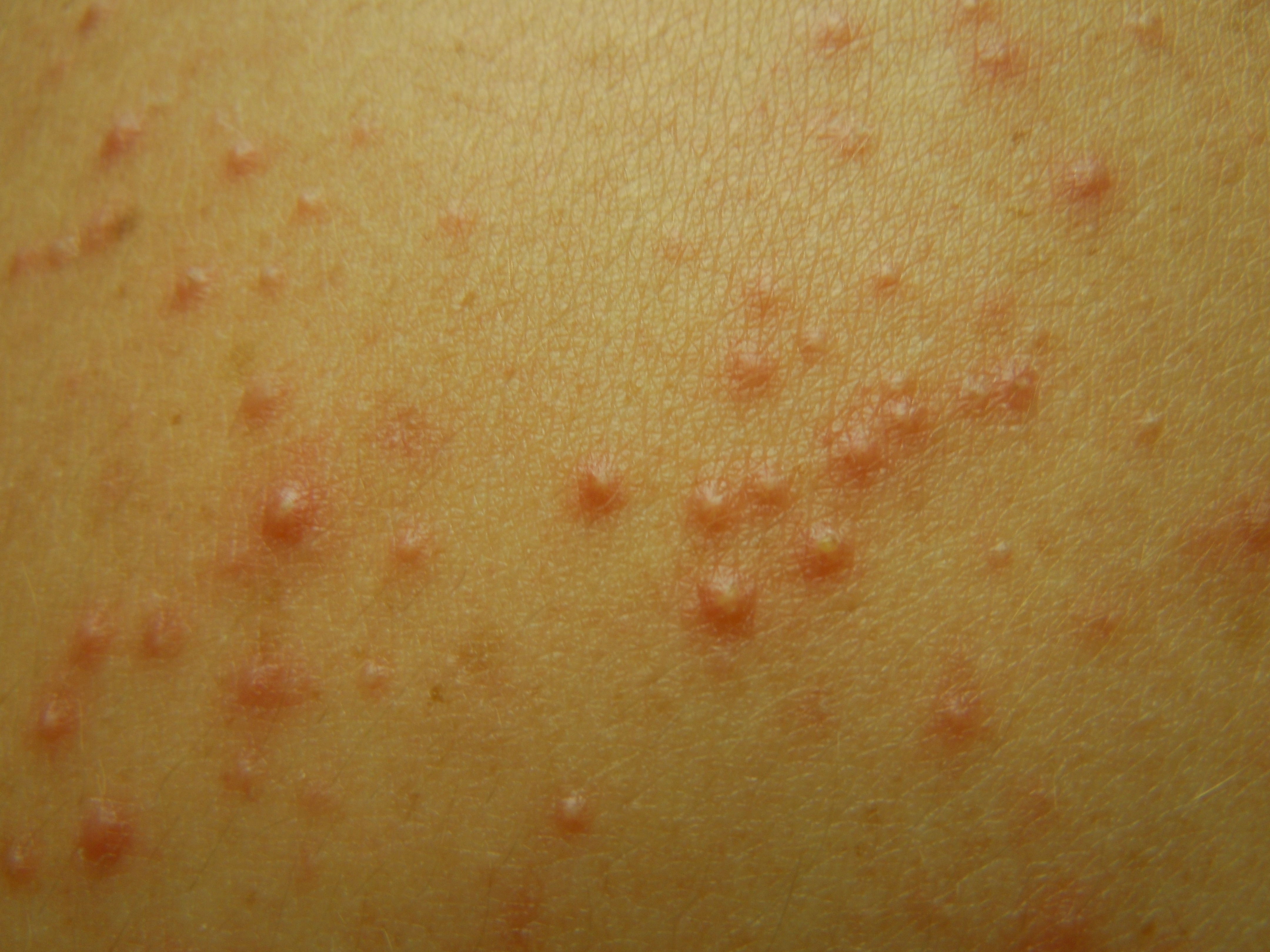 pinprick red dots, itchy skin, wrongly diagnosed - Skin ...